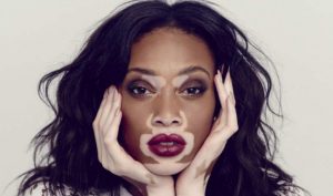 Winnie Harlow